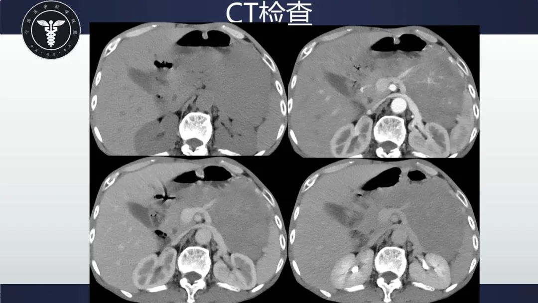 影像PPT - 【病例】胃肠道间质瘤2例CT影像-15