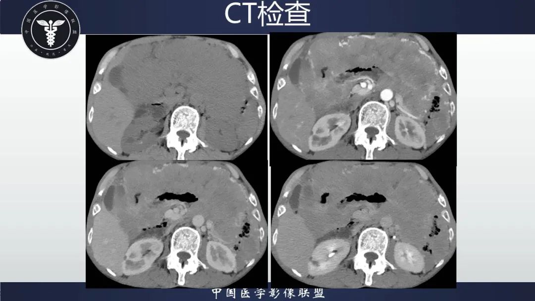 影像PPT - 【病例】胃肠道间质瘤2例CT影像-16