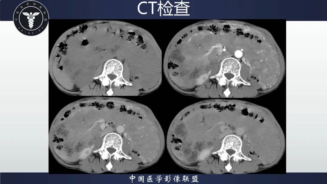 影像PPT - 【病例】胃肠道间质瘤2例CT影像-17