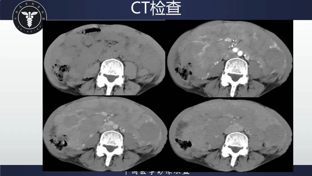 影像PPT - 【病例】胃肠道间质瘤2例CT影像-18