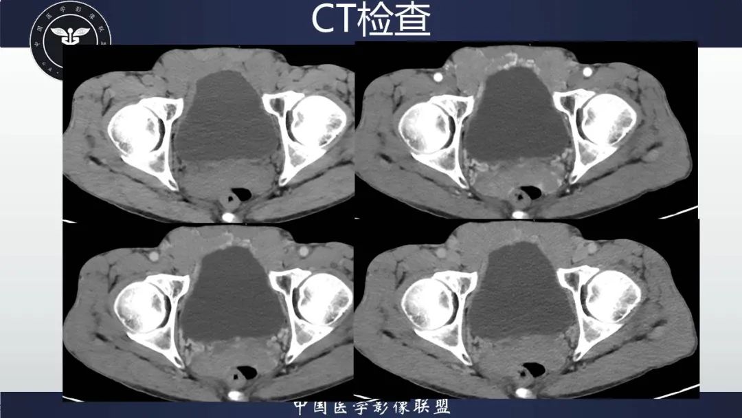 影像PPT - 【病例】胃肠道间质瘤2例CT影像-19