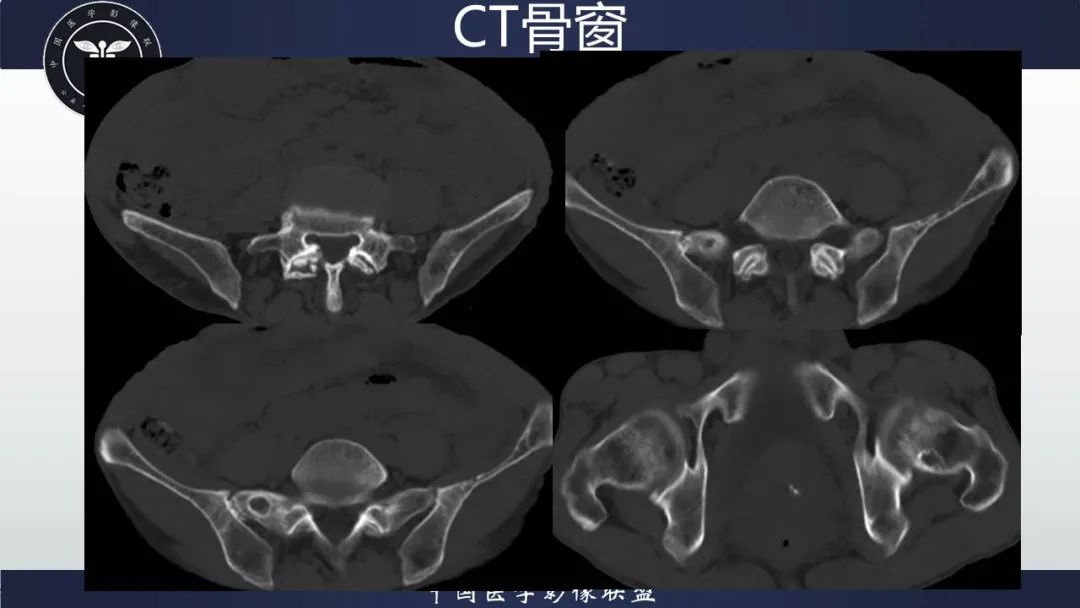 影像PPT - 【病例】胃肠道间质瘤2例CT影像-20