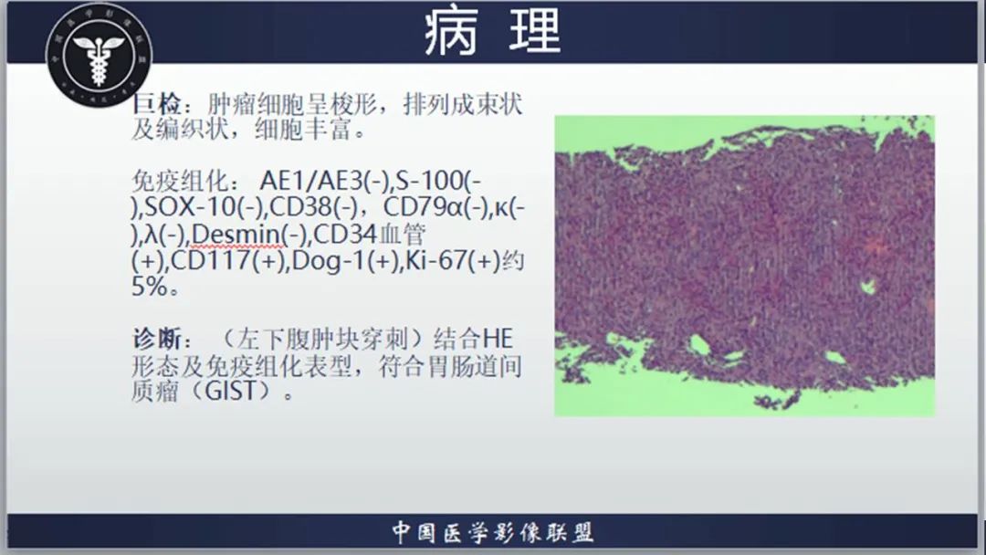 影像PPT - 【病例】胃肠道间质瘤2例CT影像-21