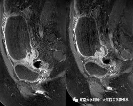 影像PPT - 【病例】卵巢囊肿蒂扭转1例MR影像-5