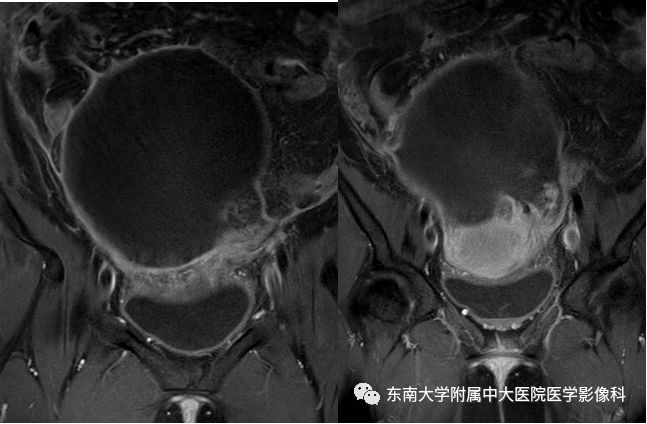 影像PPT - 【病例】卵巢囊肿蒂扭转1例MR影像-6