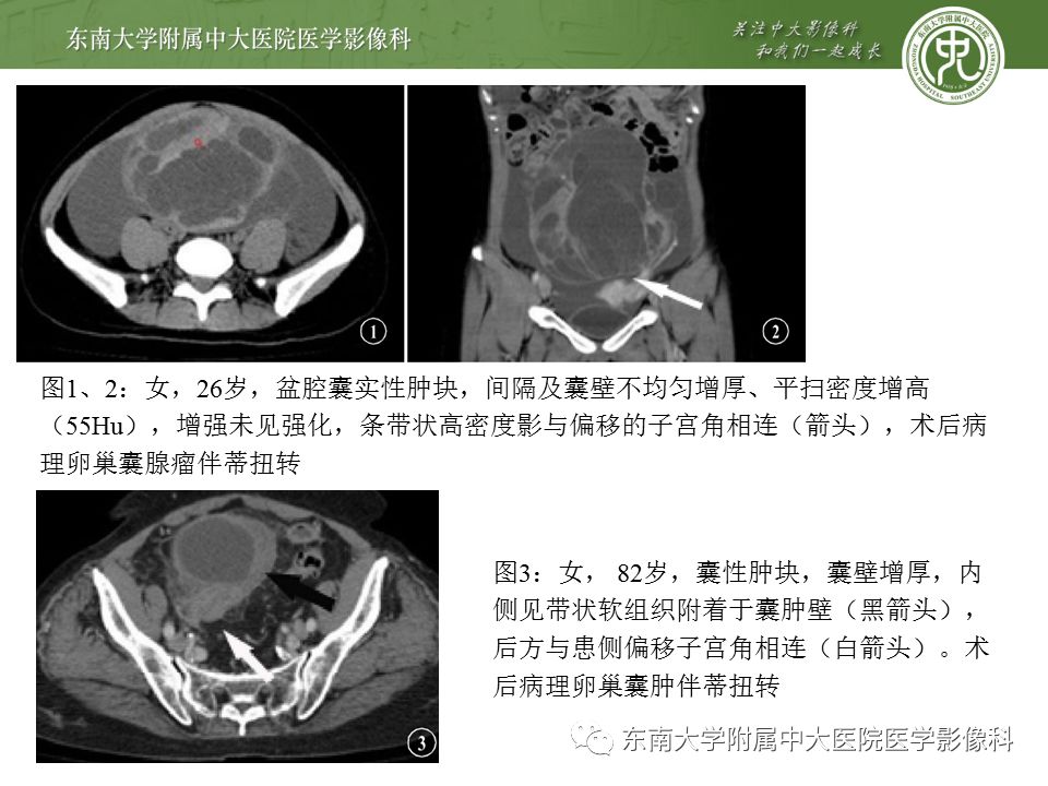 影像PPT - 【病例】卵巢囊肿蒂扭转1例MR影像-13