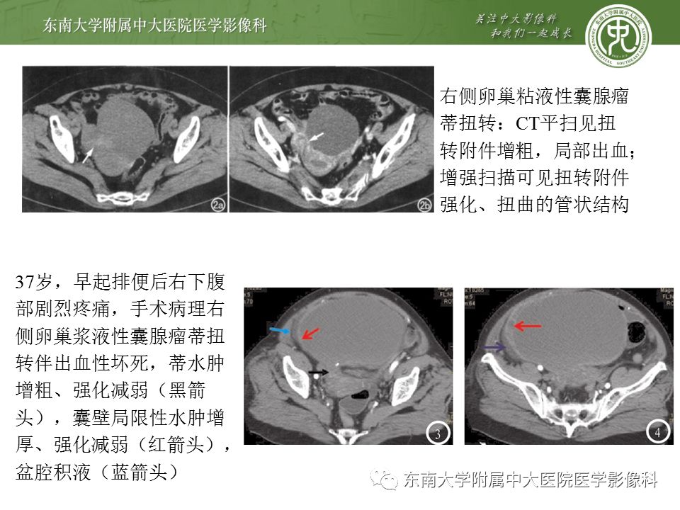 影像PPT - 【病例】卵巢囊肿蒂扭转1例MR影像-14