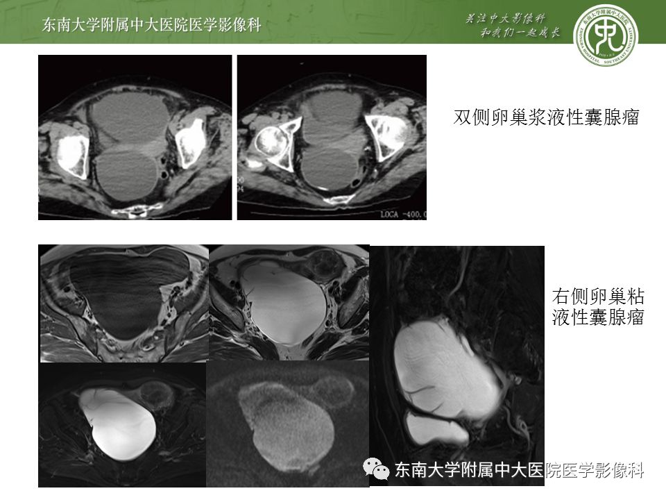 影像PPT - 【病例】卵巢囊肿蒂扭转1例MR影像-16