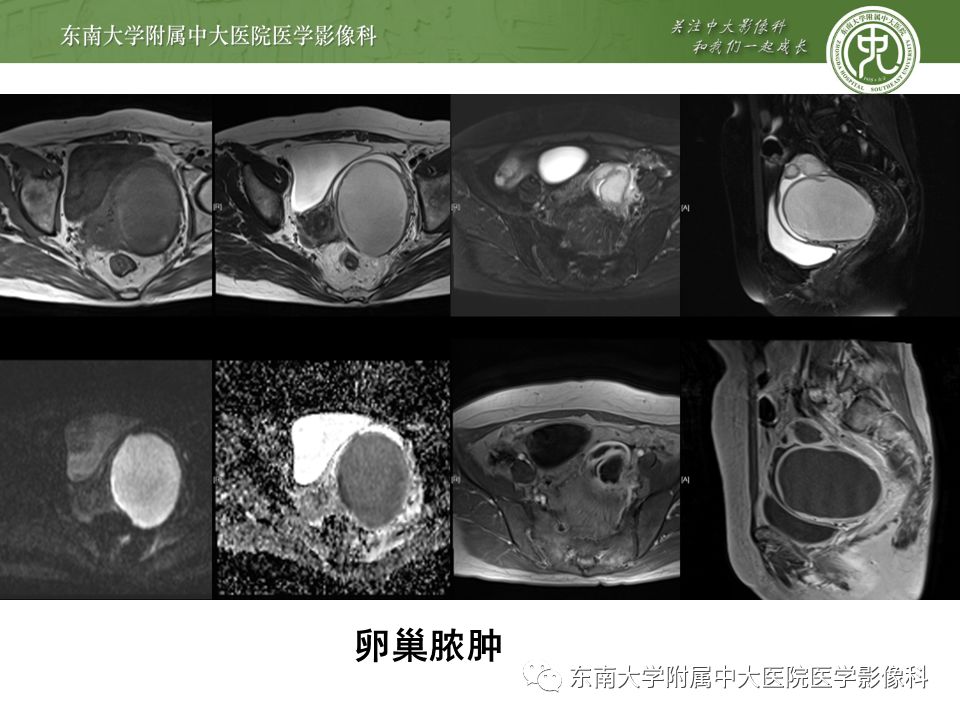 影像PPT - 【病例】卵巢囊肿蒂扭转1例MR影像-19