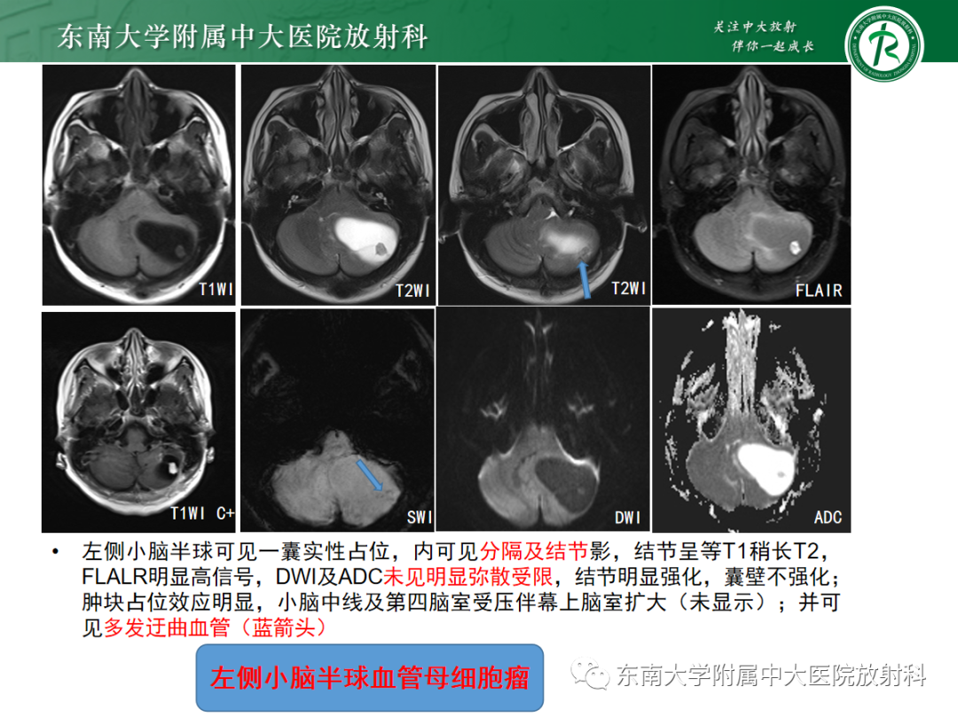 影像PPT - 【病例】成人小脑血管母细胞瘤1例MR影像-6
