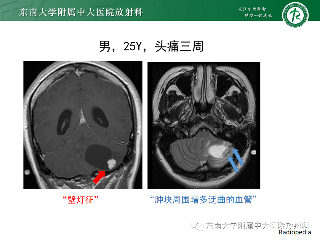 影像PPT - 【病例】成人小脑血管母细胞瘤1例MR影像-7