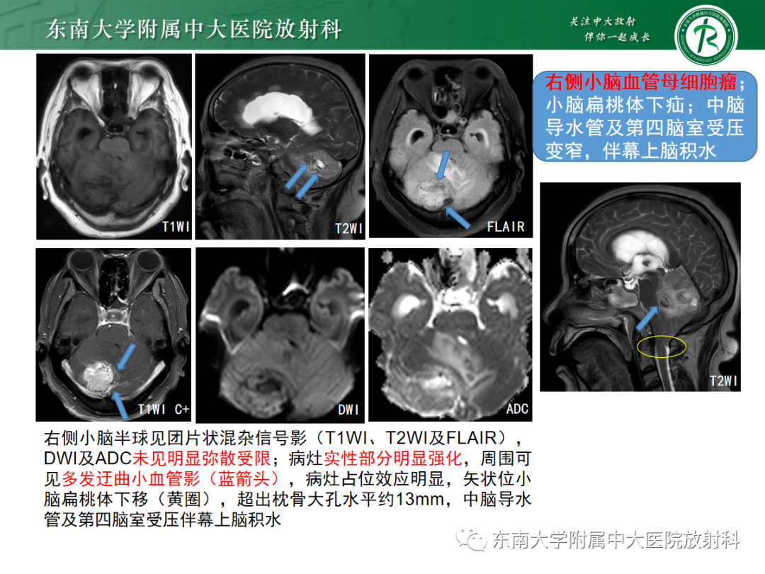 影像PPT - 【病例】成人小脑血管母细胞瘤1例MR影像-9