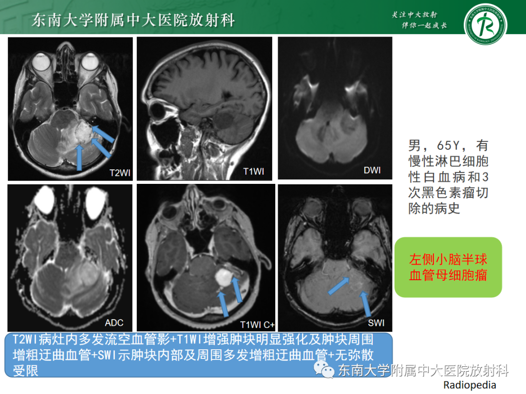 影像PPT - 【病例】成人小脑血管母细胞瘤1例MR影像-10
