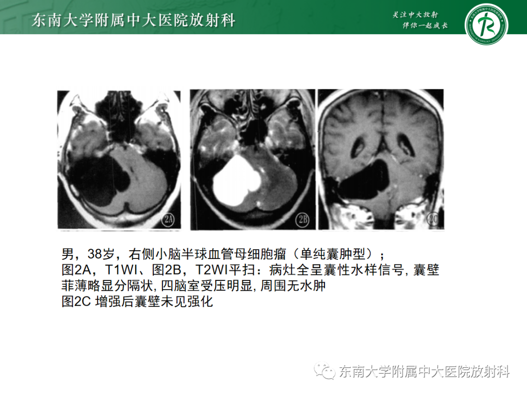 影像PPT - 【病例】成人小脑血管母细胞瘤1例MR影像-12