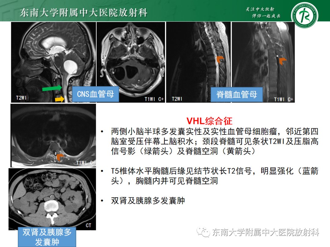 影像PPT - 【病例】成人小脑血管母细胞瘤1例MR影像-14