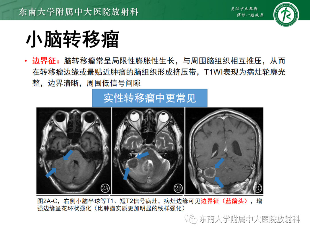 影像PPT - 【病例】成人小脑血管母细胞瘤1例MR影像-16