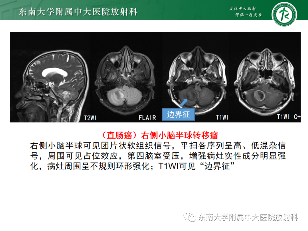 影像PPT - 【病例】成人小脑血管母细胞瘤1例MR影像-17