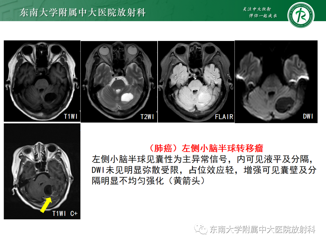 影像PPT - 【病例】成人小脑血管母细胞瘤1例MR影像-18