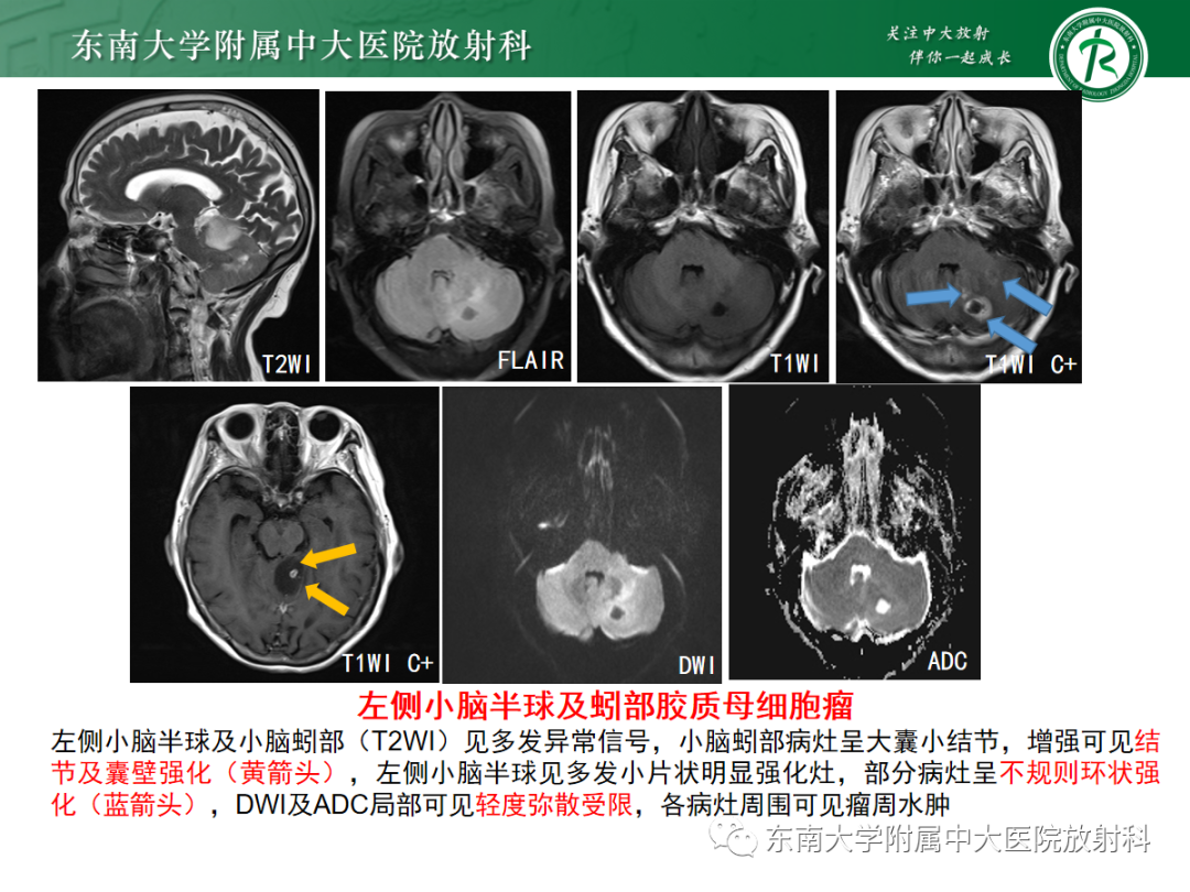 影像PPT - 【病例】成人小脑血管母细胞瘤1例MR影像-21