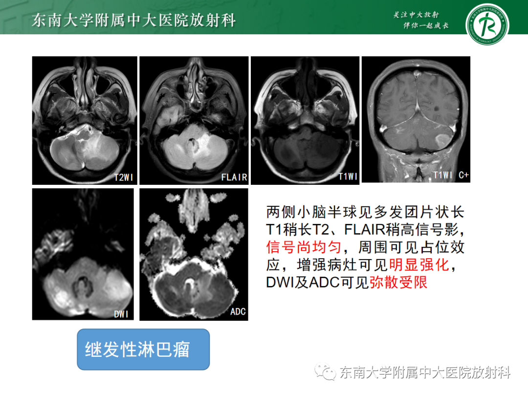 影像PPT - 【病例】成人小脑血管母细胞瘤1例MR影像-23