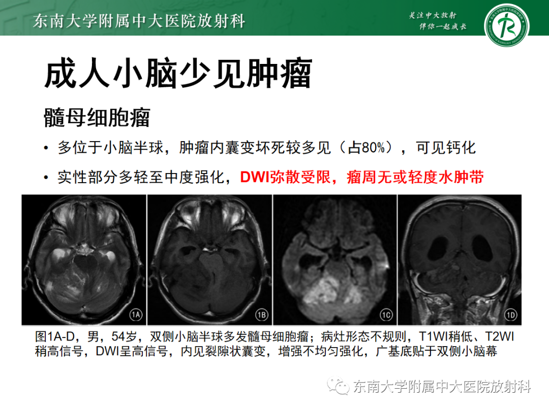 影像PPT - 【病例】成人小脑血管母细胞瘤1例MR影像-24