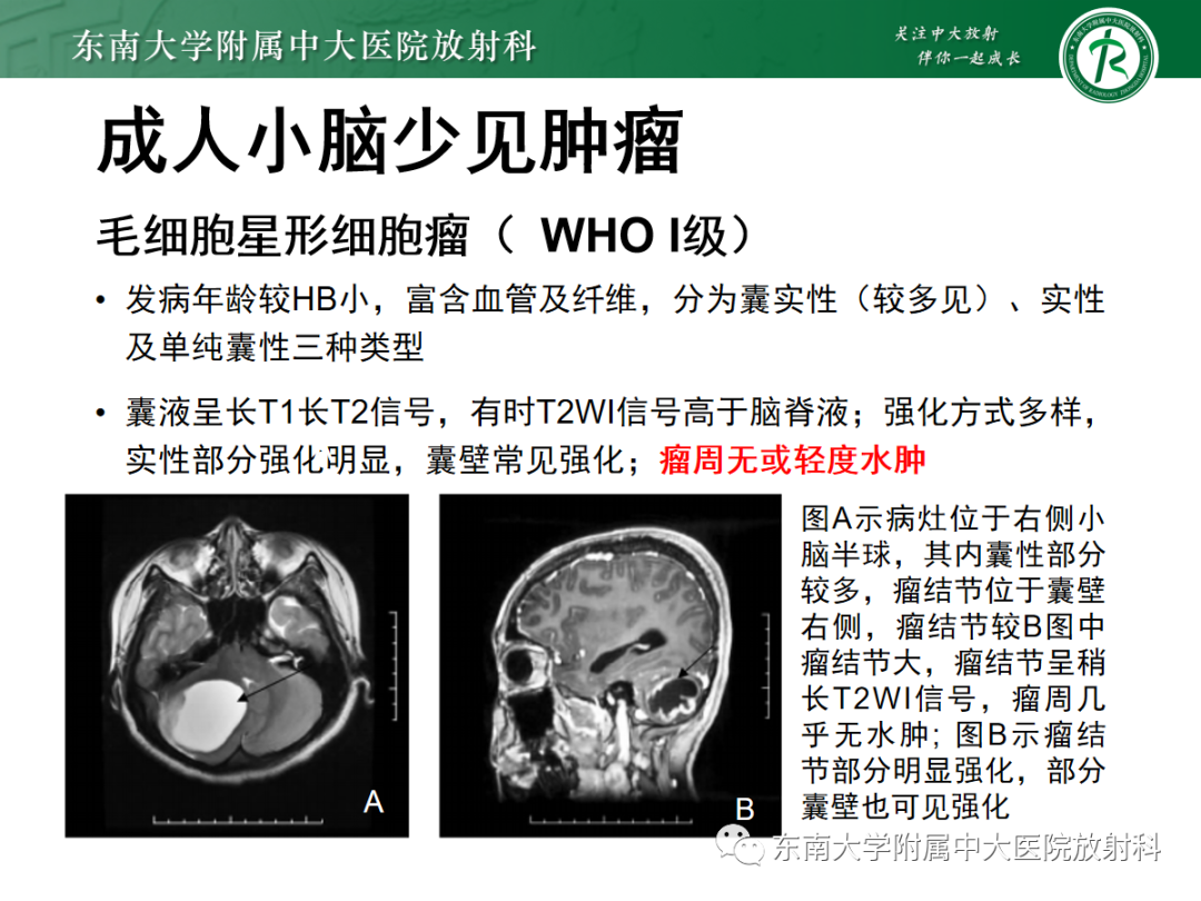 影像PPT - 【病例】成人小脑血管母细胞瘤1例MR影像-25