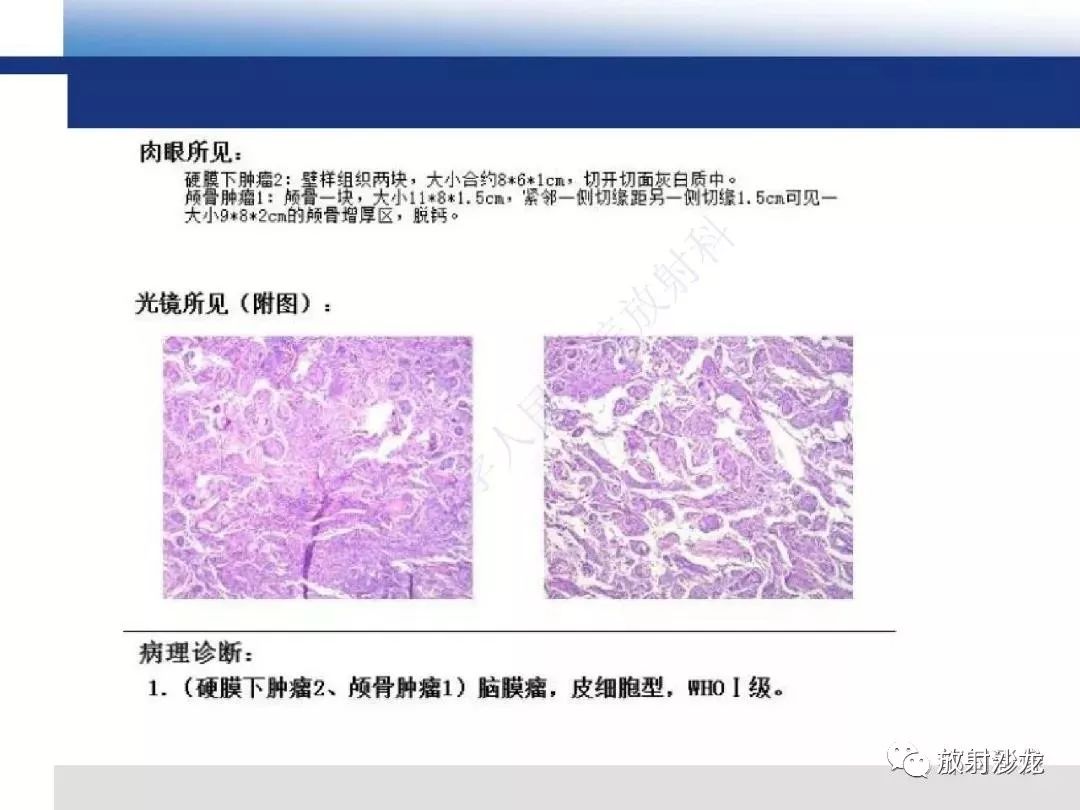 影像PPT - 【PPT】板障型脑膜瘤的影像诊断-5