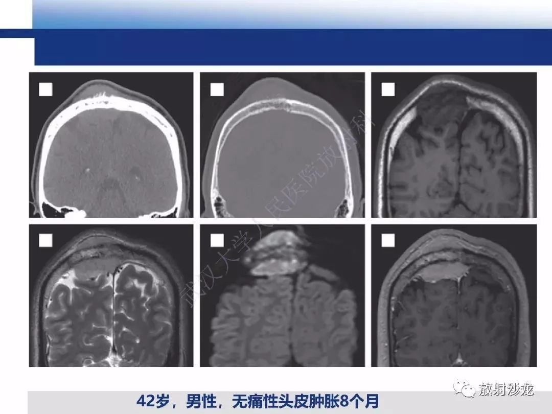 影像PPT - 【PPT】板障型脑膜瘤的影像诊断-14