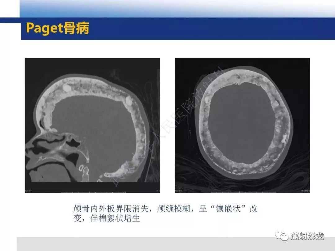 影像PPT - 【PPT】板障型脑膜瘤的影像诊断-18