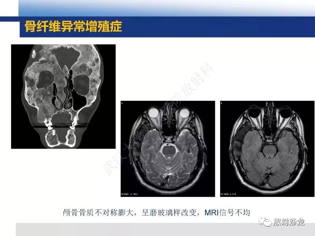 影像PPT - 【PPT】板障型脑膜瘤的影像诊断-19