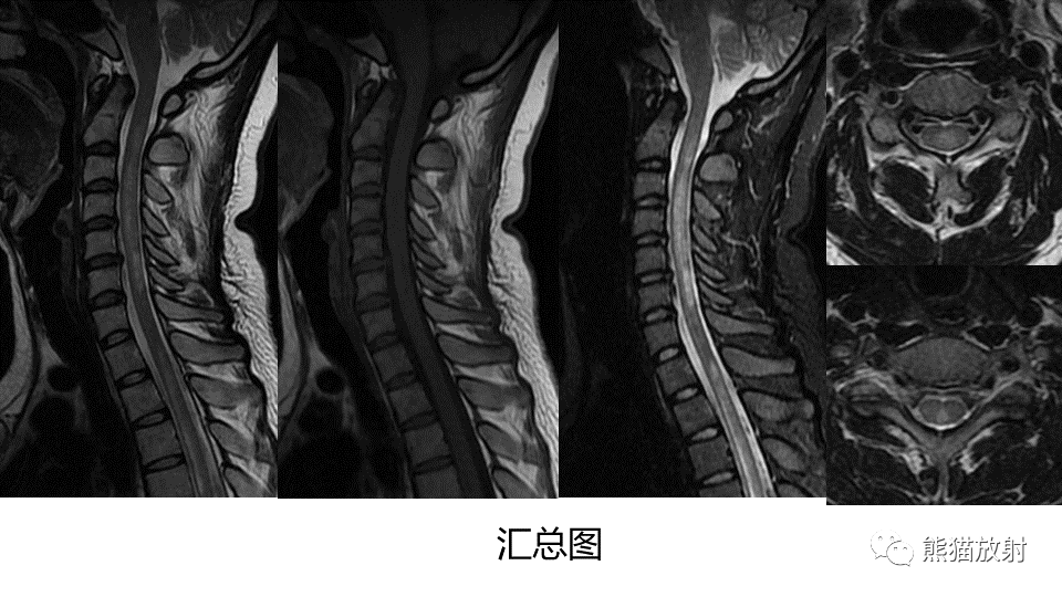 影像PPT - 【病例】视神经脊髓炎2例MR影像-18