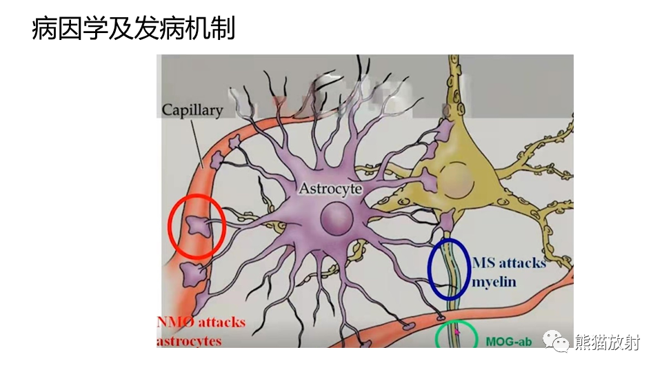 影像PPT - 【病例】视神经脊髓炎2例MR影像-22