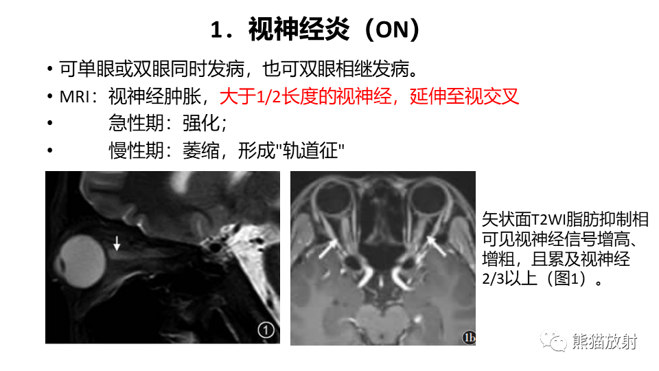 影像PPT - 【病例】视神经脊髓炎2例MR影像-30