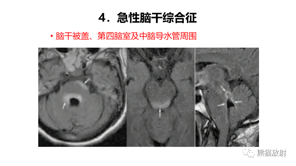 影像PPT - 【病例】视神经脊髓炎2例MR影像-36