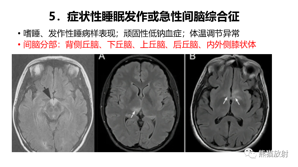 影像PPT - 【病例】视神经脊髓炎2例MR影像-37