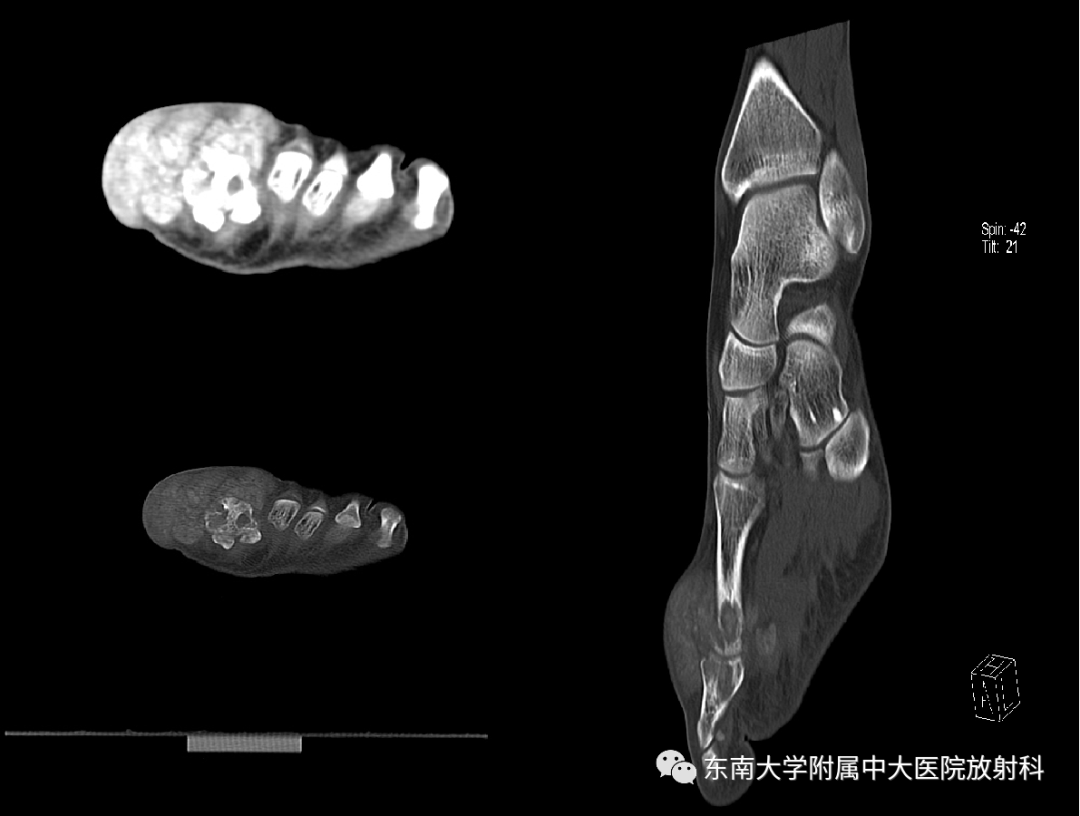 影像PPT - 【病例】痛风性关节炎1例CT影像-1 影像PPT - 【病例】痛风性关节炎1例CT影像-1