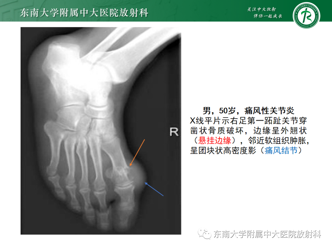 影像PPT - 【病例】痛风性关节炎1例CT影像-9 影像PPT - 【病例】痛风性关节炎1例CT影像-9