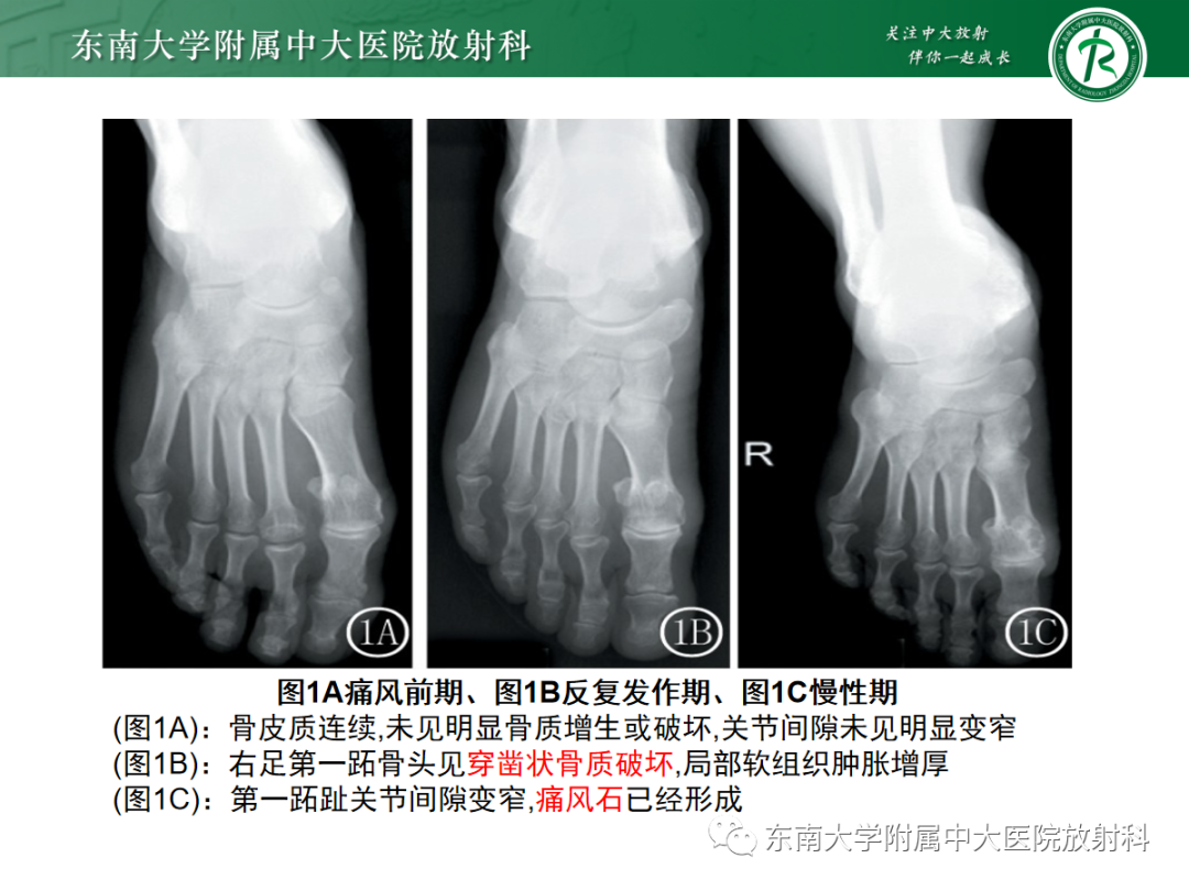 影像PPT - 【病例】痛风性关节炎1例CT影像-10 影像PPT - 【病例】痛风性关节炎1例CT影像-10