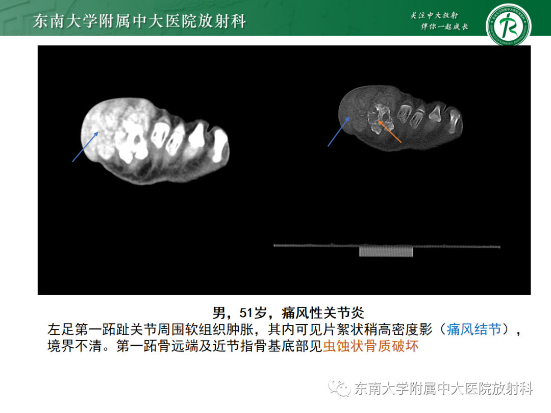 影像PPT - 【病例】痛风性关节炎1例CT影像-12 影像PPT - 【病例】痛风性关节炎1例CT影像-12