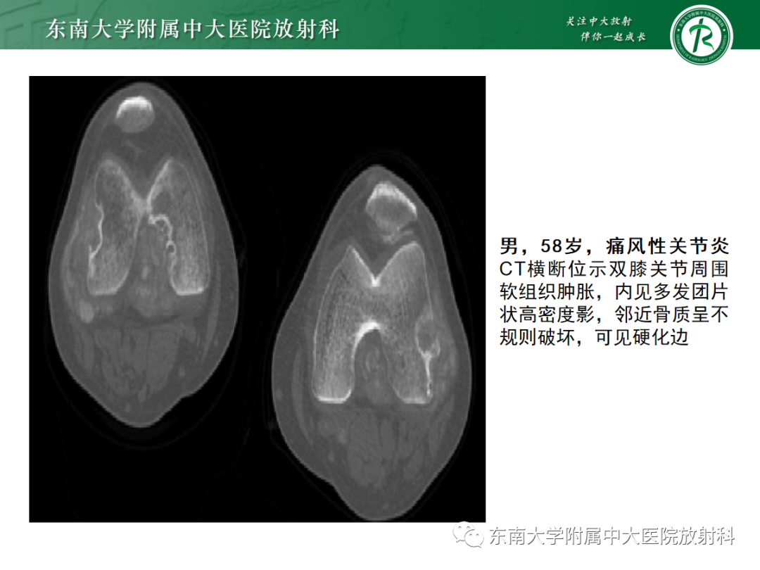 影像PPT - 【病例】痛风性关节炎1例CT影像-13 影像PPT - 【病例】痛风性关节炎1例CT影像-13