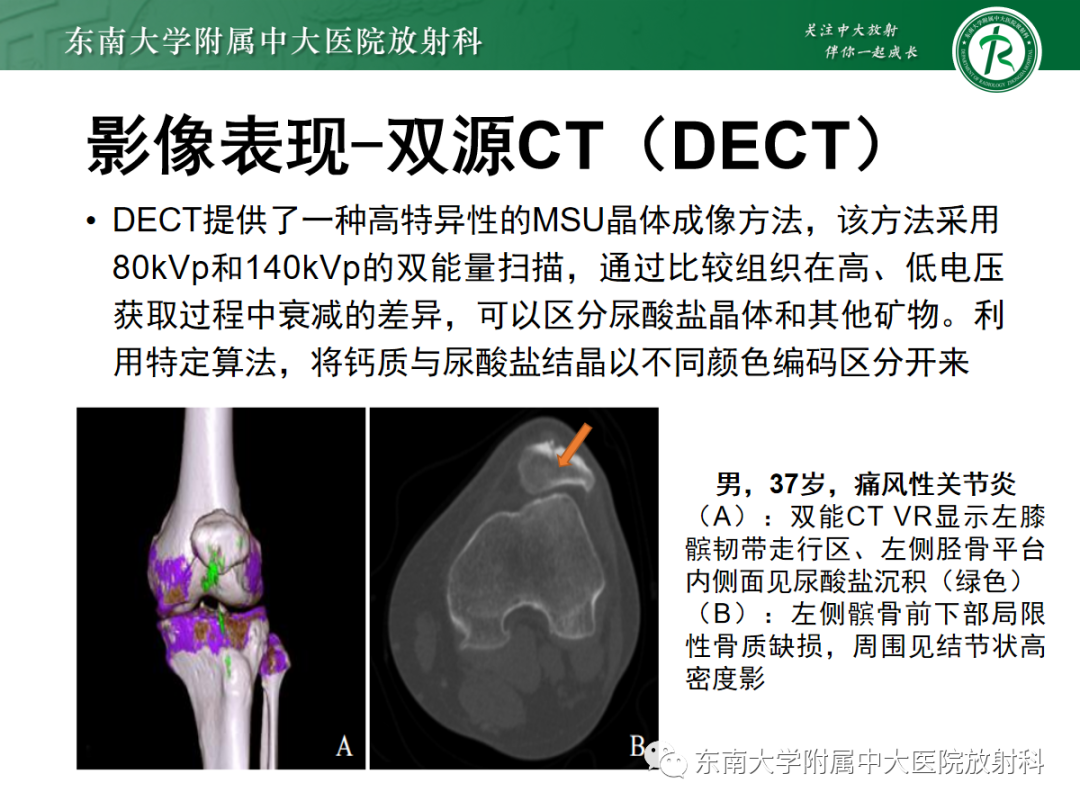 影像PPT - 【病例】痛风性关节炎1例CT影像-14 影像PPT - 【病例】痛风性关节炎1例CT影像-14