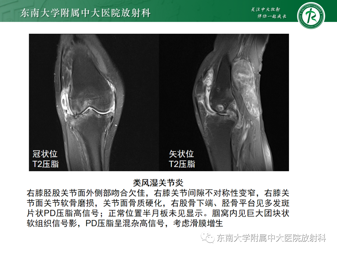 影像PPT - 【病例】痛风性关节炎1例CT影像-20 影像PPT - 【病例】痛风性关节炎1例CT影像-20