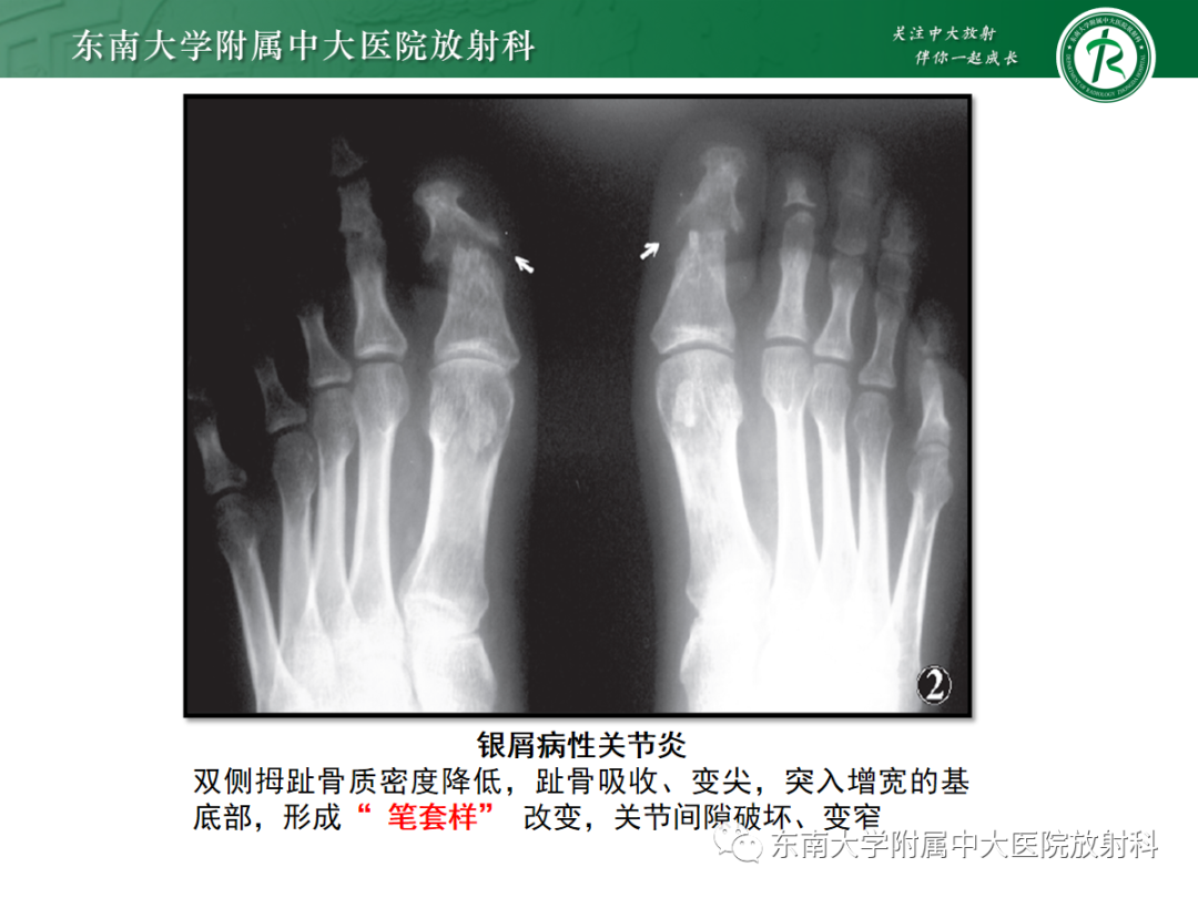 影像PPT - 【病例】痛风性关节炎1例CT影像-23 影像PPT - 【病例】痛风性关节炎1例CT影像-23