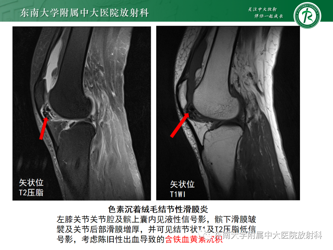 影像PPT - 【病例】痛风性关节炎1例CT影像-26 影像PPT - 【病例】痛风性关节炎1例CT影像-26