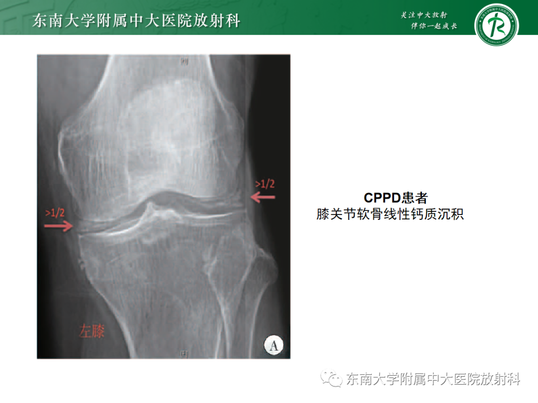 影像PPT - 【病例】痛风性关节炎1例CT影像-28 影像PPT - 【病例】痛风性关节炎1例CT影像-28