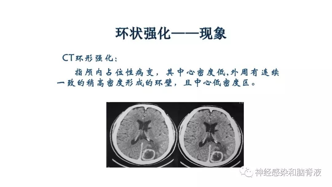 影像PPT - 【PPT】颅内环形强化：从原理到现象-2