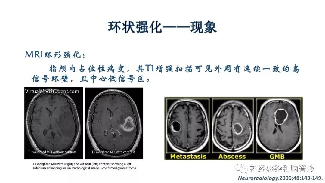 影像PPT - 【PPT】颅内环形强化：从原理到现象-3