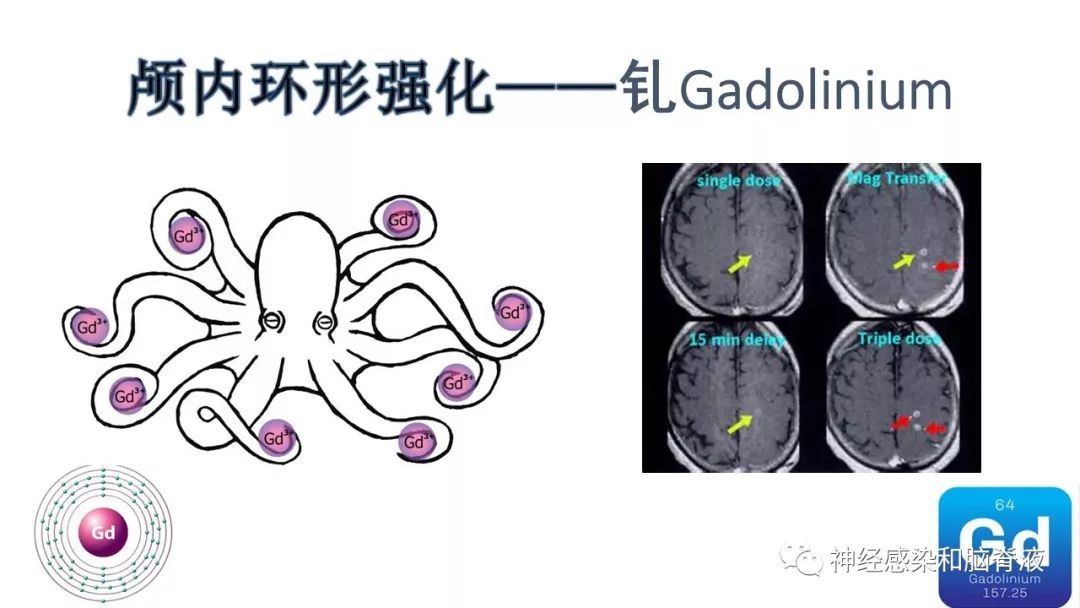影像PPT - 【PPT】颅内环形强化：从原理到现象-4