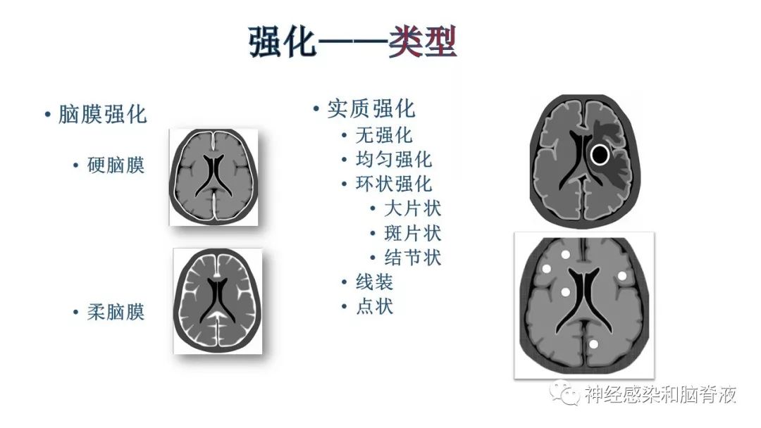 影像PPT - 【PPT】颅内环形强化：从原理到现象-8