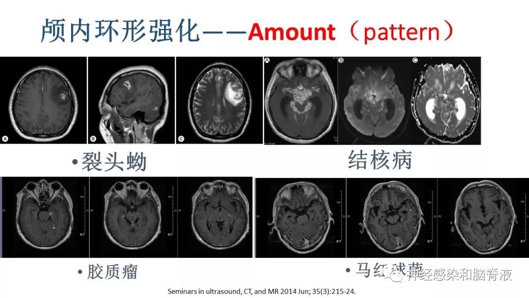 影像PPT - 【PPT】颅内环形强化：从原理到现象-27